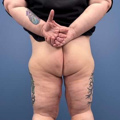 Thigh Lift Before & After Patient #579