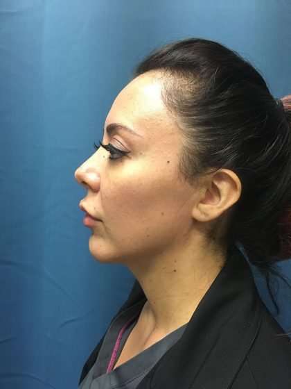 Submentoplasty Before & After Patient #586