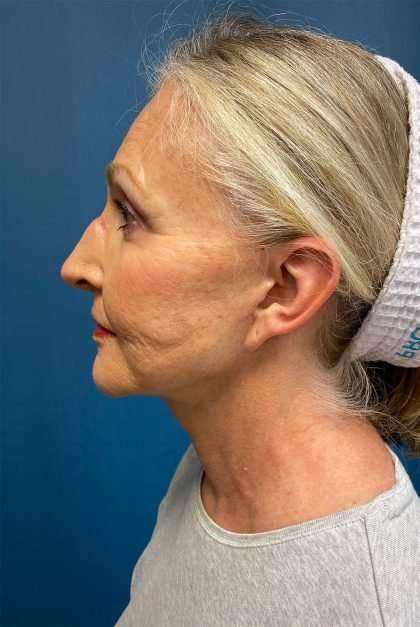 Submentoplasty Before & After Patient #654