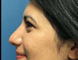 Rhinoplasty Before & After Patient #667