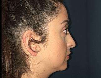 Rhinoplasty Before & After Patient #680
