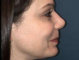 Rhinoplasty Before & After Patient #693