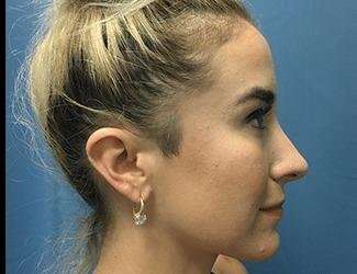 Rhinoplasty Before & After Patient #706