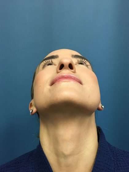 Rhinoplasty Before & After Patient #715