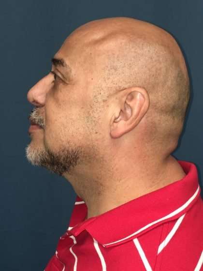 Rhinoplasty Before & After Patient #722