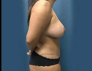 Mommy Makeover Before & After Patient #743