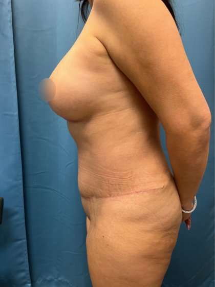 Mommy Makeover Before & After Patient #944