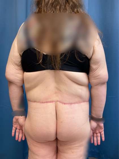 Massive Weight Loss Before & After Patient #986