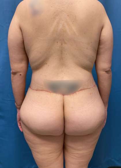 Lower Body Lift Before & After Patient #1008
