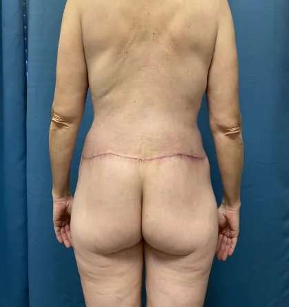Lower Body Lift Before & After Patient #1034