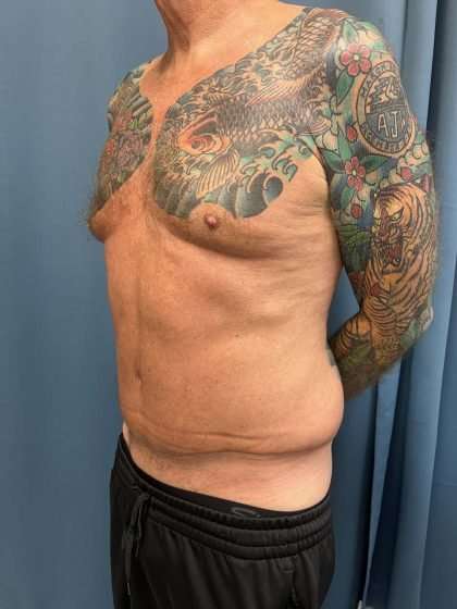 Tummy Tuck Before & After Patient #322