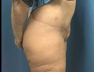 Lower Body Lift Before & After Patient #1047