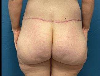 Lower Body Lift Before & After Patient #1050