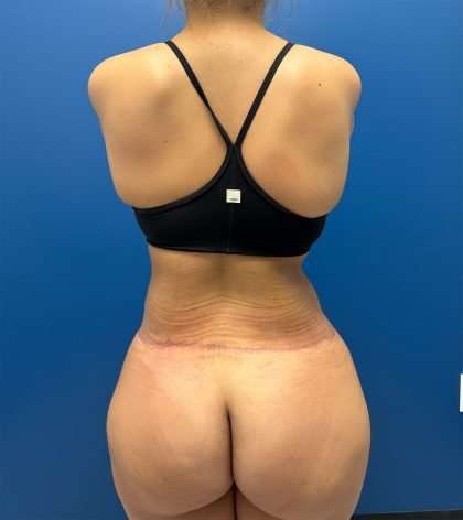 Lower Body Lift Before & After Patient #1081
