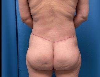 Lower Body Lift Before & After Patient #1094
