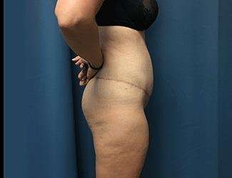 Lower Body Lift Before & After Patient #1114