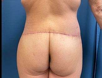 Lower Body Lift Before & After Patient #1127