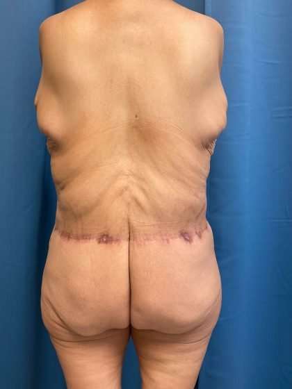 Lower Body Lift Before & After Patient #1141