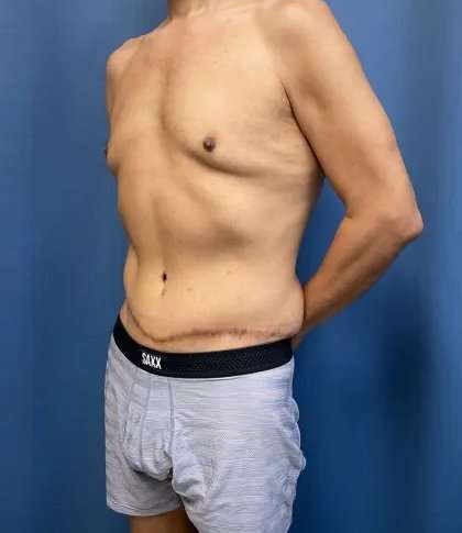 Tummy Tuck Before & After Patient #333