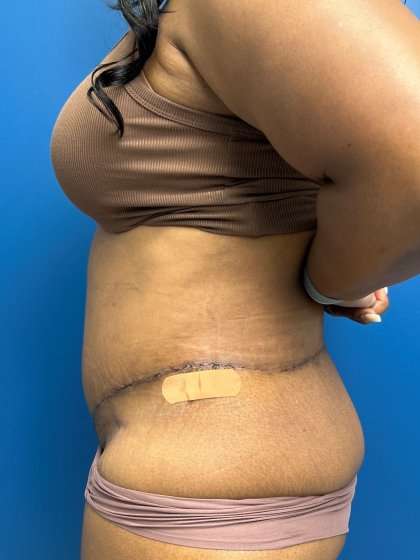 Lower Body Lift Before & After Patient #1154