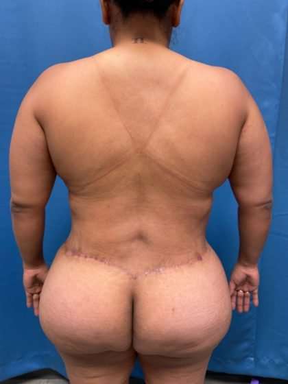 Lower Body Lift Before & After Patient #1161
