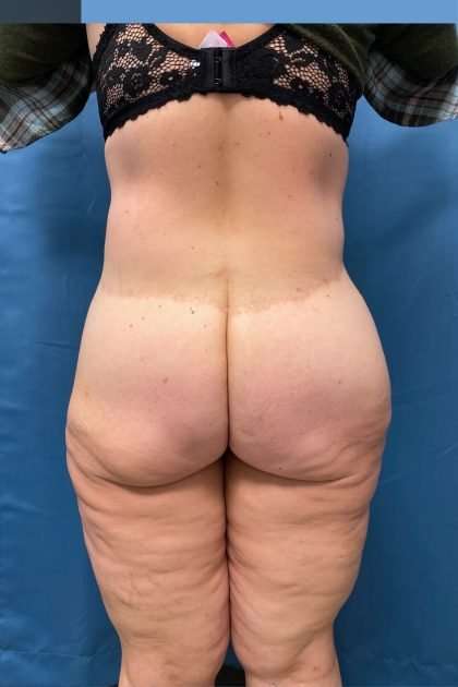 Lower Body Lift Before & After Patient #1174