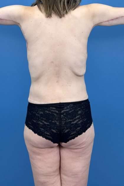 Lower Body Lift Before & After Patient #1187