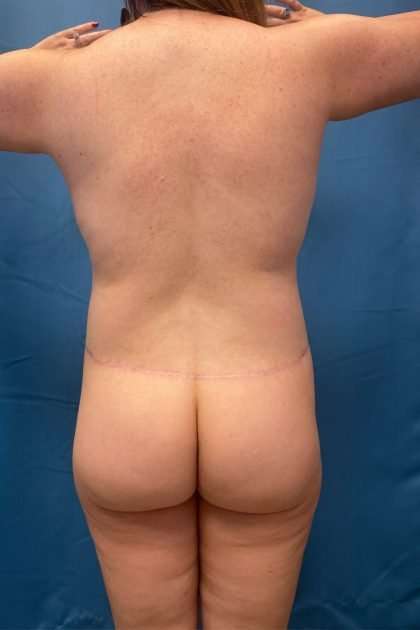 Lower Body Lift Before & After Patient #1200