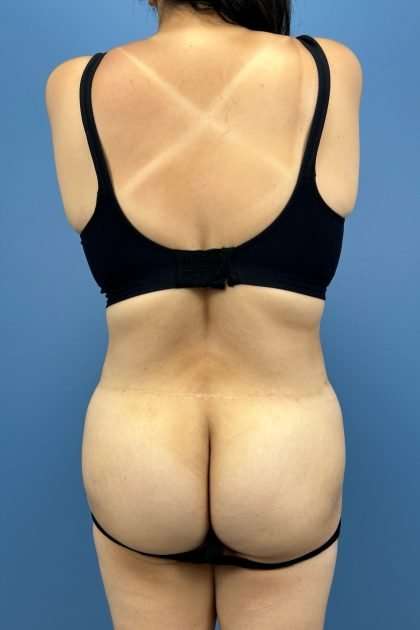 Lower Body Lift Before & After Patient #1213