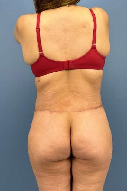 Lower Body Lift Before & After Patient #1226