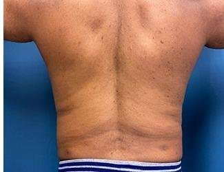 Liposuction Before & After Patient #1246