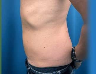 Liposuction Before & After Patient #1257