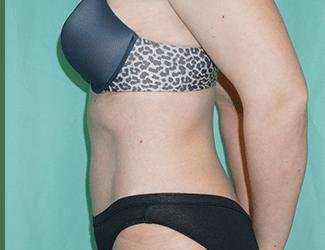 Tummy Tuck Before & After Patient #340
