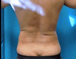 Liposuction Before & After Patient #1262