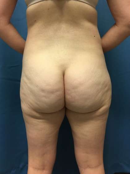 Liposuction Before & After Patient #1268