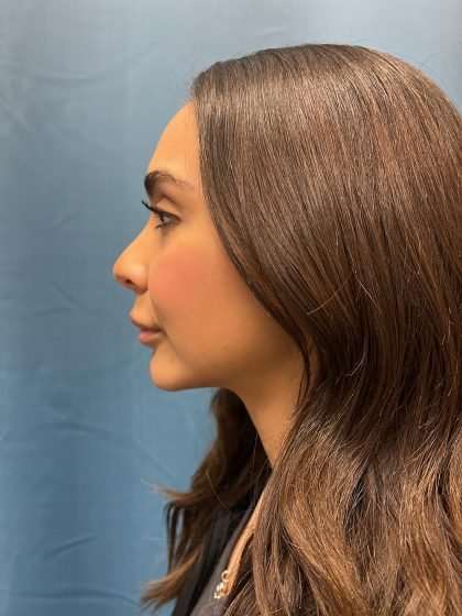 Lip Lift Before & After Patient #1279