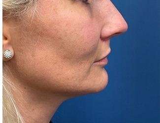 Lip Lift Before & After Patient #1289