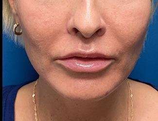 Lip Lift Before & After Patient #1293