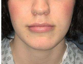 Lip Lift Before & After Patient #1296