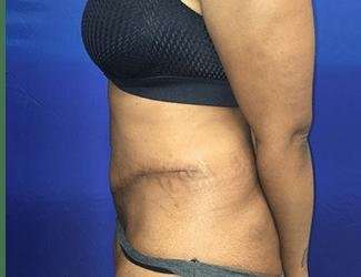 Tummy Tuck Before & After Patient #349