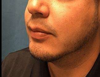 Facial Implants Before & After Patient #1403