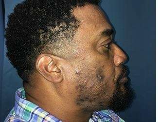 Facial Implants Before & After Patient #1440