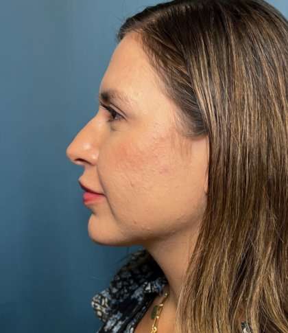 Facial Implants Before & After Patient #1486