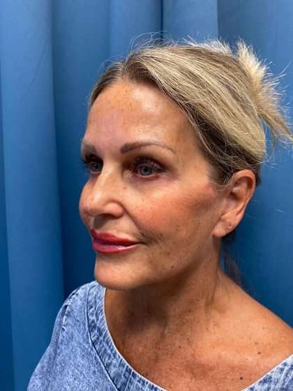 Facelift And Necklift Before & After Patient #1497