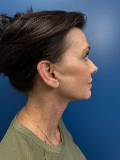 Facelift And Necklift Before & After Patient #1506