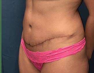 Tummy Tuck Before & After Patient #358