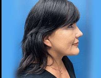 Facelift And Necklift Before & After Patient #1513
