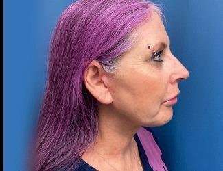 Facelift And Necklift Before & After Patient #1520
