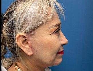 Facelift And Necklift Before & After Patient #1531