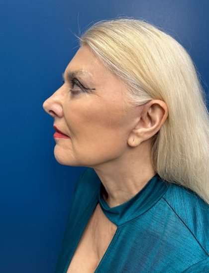 Facelift And Necklift Before & After Patient #1542